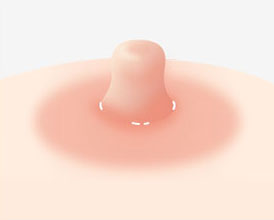 절개창을 꼼꼼히 봉합