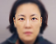 눈 before after