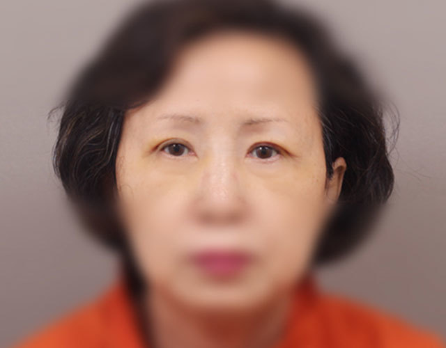 눈 after 이미지