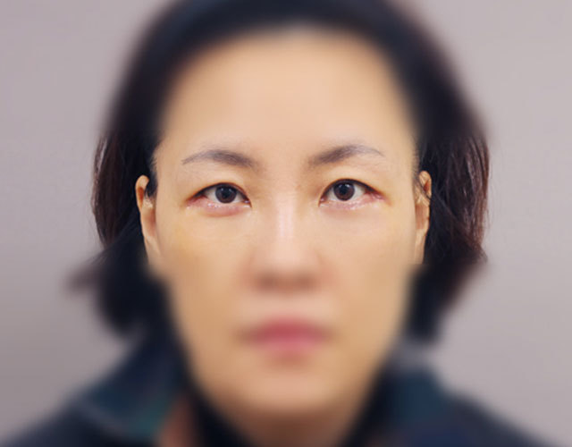 눈 after 이미지