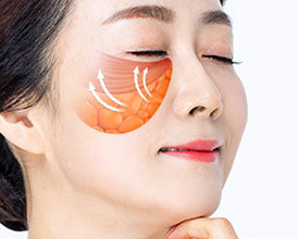 근막층을 포함한 전체적인 조직을 당겨줌