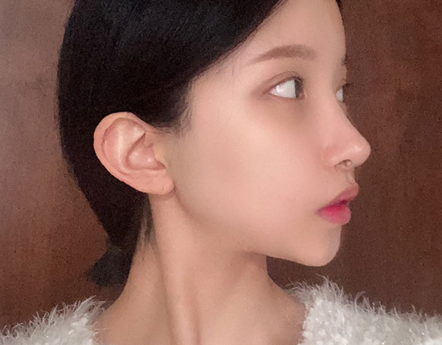 안면윤곽 after 이미지