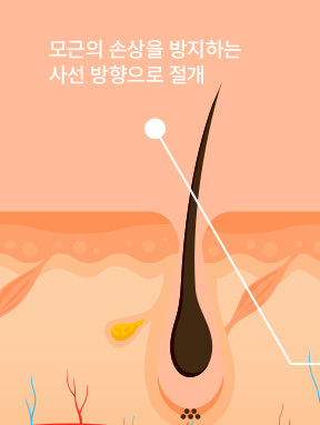 나나성형외과 이마축소술 모근 보존 절개 방식 이미지, 모발 성장 방향을 고려한 사선 절개 구조