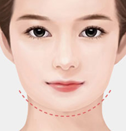 나나성형외과 안면윤곽 재수술 필요 사례 이미지, 1차 윤곽수술 후 정면에서 갸름해지지 않은 경우