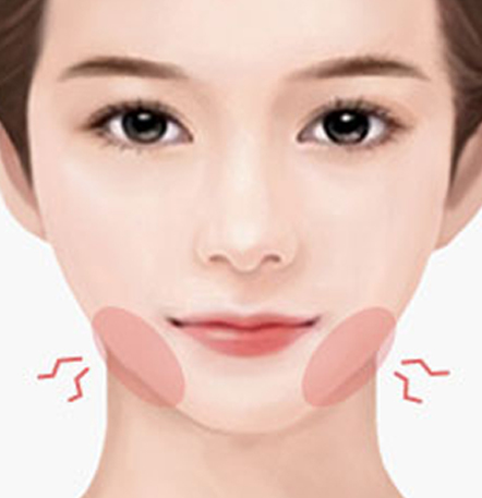 나나성형외과 안면윤곽 재수술 필요 사례 이미지, 1차 윤곽수술 후 턱 통증이나 소리가 나는 경우