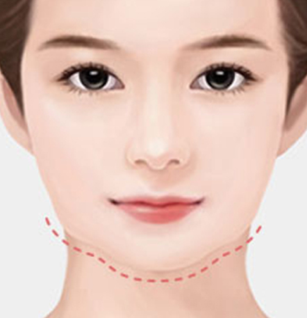 나나성형외과 안면윤곽 재수술 필요 사례 이미지, 1차 윤곽수술 후 턱선이 울퉁불퉁해진 경우