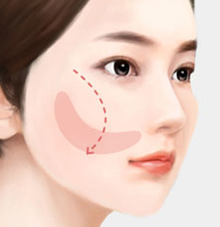 나나성형외과 안면윤곽 재수술 필요 사례 이미지, 1차 윤곽수술 후 절골 부위가 함몰되어 윤곽 재수술을 고려하는 경우