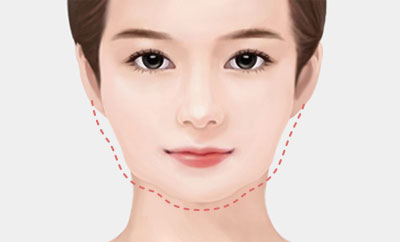 윤곽이 매끈하지 못한 경우