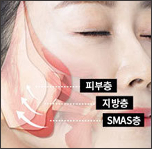 유지인대를 박리
