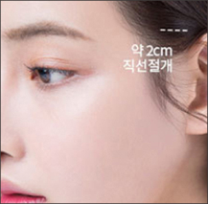 최소 절개 진행