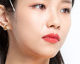 피부를 최소 절개