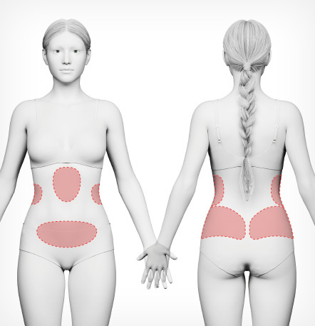 복부 라인 지방흡입