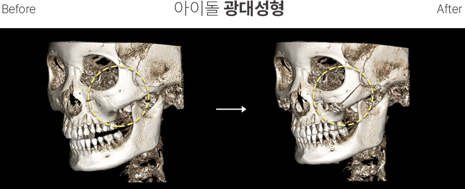 남자윤곽 CT3