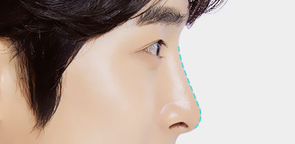 예쁨의 시작, 남자 - 엣지라인코성형 예쁨의 시작, 남자 - 엣지라인코성형