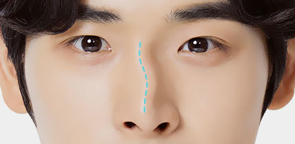 예쁨의 시작, 남자 - 엣지라인코성형 예쁨의 시작, 남자 - 엣지라인코성형