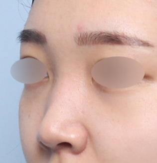 맞춤형 코성형을 진행한 낮은 코 유형 고객의 수술 전 45도 부분 이미지