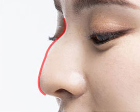 산후 매부리코 성형수술: 남녀 매부리코의 수술방법과 비용차이 비교