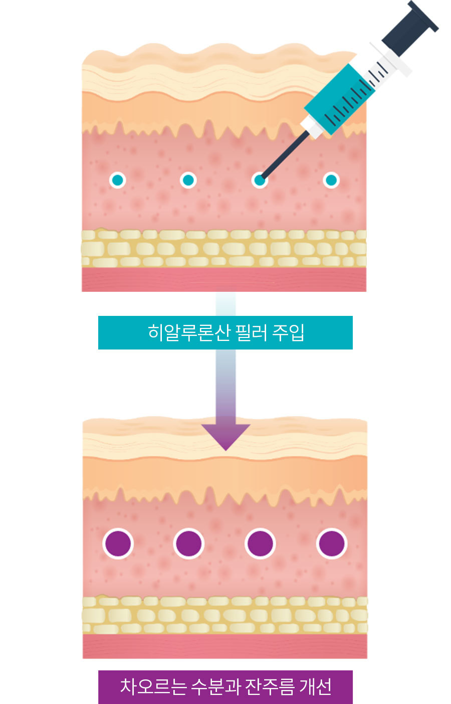 시술원리