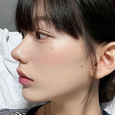 코성형 Before & After