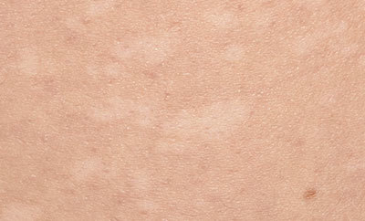 색소침착증