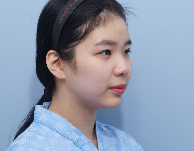 코 before이미지