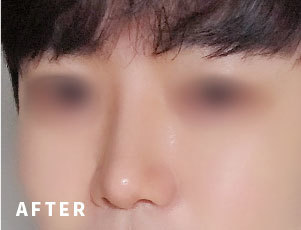 성형 후 이미지