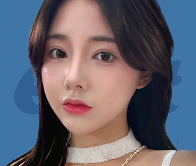 얼굴 전체 지방이식