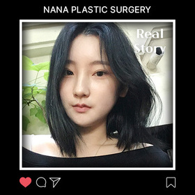 윤곽수술 3개월 후